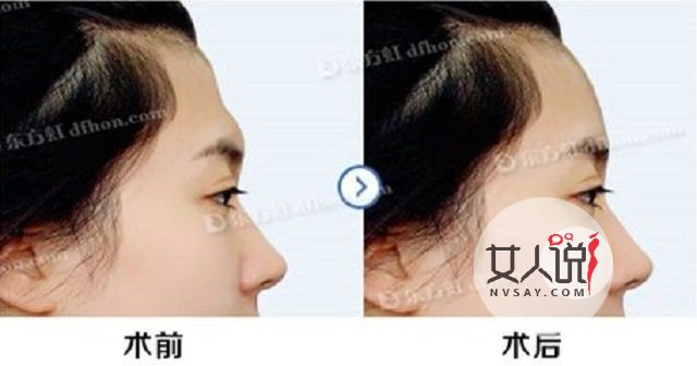 额头填充那些帮你变的更美丽的小秘密,你知道吗?