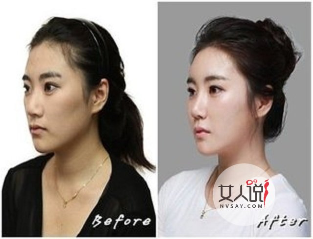 额头填充那些帮你变的更美丽的小秘密,你知道吗?