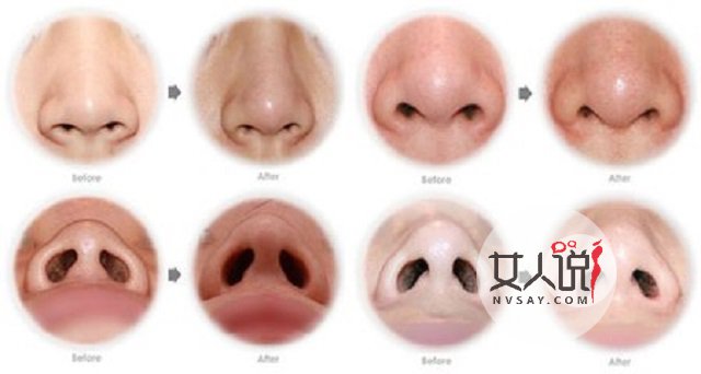 缩小鼻翼多少钱?有什么需要注意的吗?有效果吗