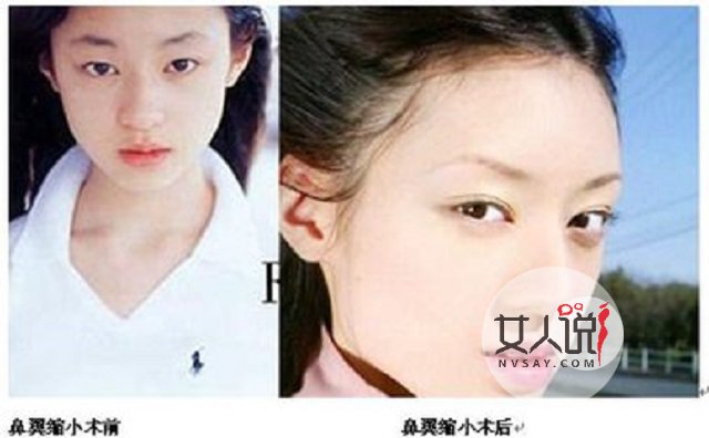 缩小鼻翼多少钱?有什么需要注意的吗?有效果吗