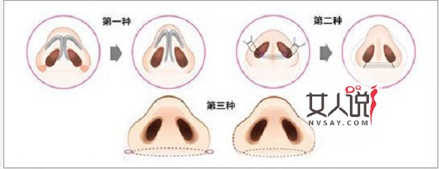 缩小鼻翼多少钱?有什么需要注意的吗?有效果吗