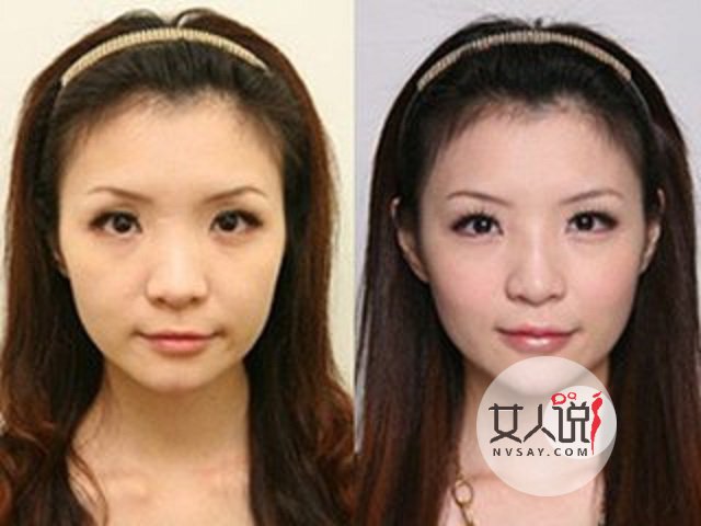 缩小鼻翼多少钱?有什么需要注意的吗?有效果吗