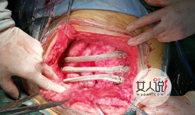 假体植入满足那些年你未完成的遗憾和不满。