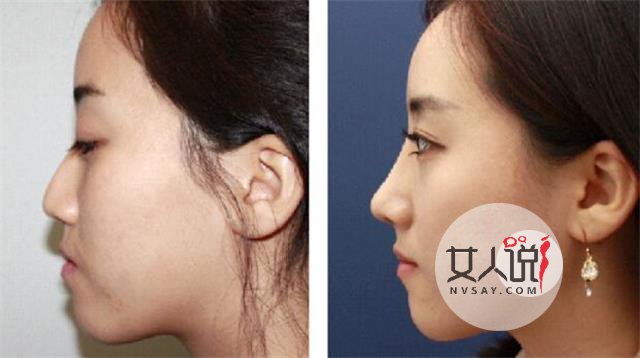 垫高鼻梁怎么样?有风险谨慎决定!