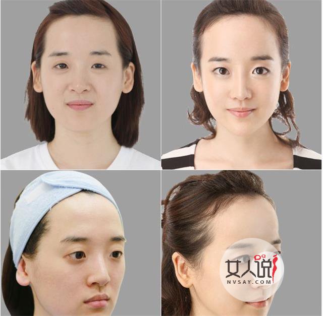 鼻子不完美？可以选择鼻部整形呀！