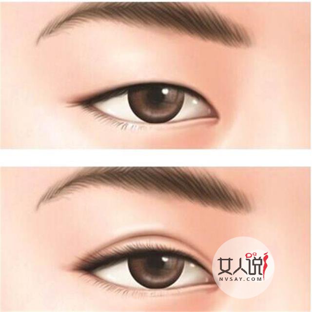 双眼皮埋线是什么,可以变好看吗?