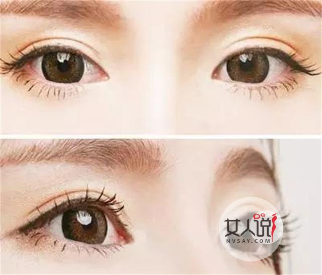 双眼皮埋线是什么，可以变好看吗？
