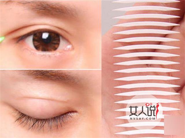 双眼皮埋线是什么，可以变好看吗？