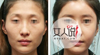 自体脂肪面部填充术靠谱吗?爱美的你快来看看