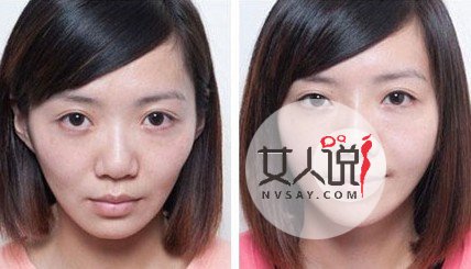 自体脂肪面部填充术靠谱吗?爱美的你快来看看