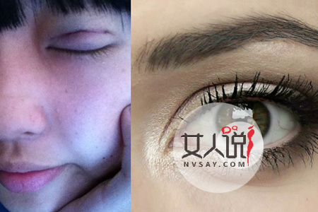 想拥有一双美丽的大眼睛吗?了解做双眼皮多少钱