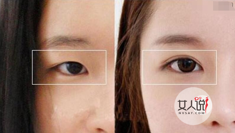 想拥有一双美丽的大眼睛吗？了解做双眼皮多少钱