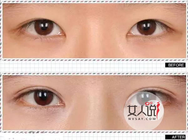 想拥有一双美丽的大眼睛吗？了解做双眼皮多少钱