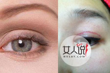 想拥有一双美丽的大眼睛吗？了解做双眼皮多少钱