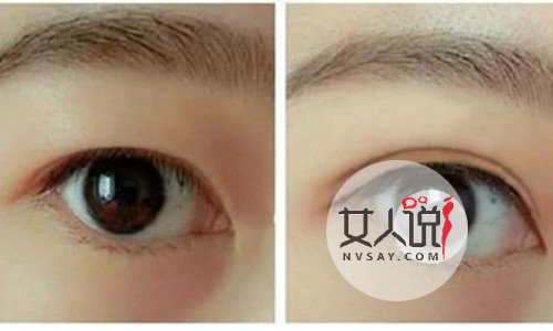 想要变美的你,了解韩式三点双眼皮价格吗?