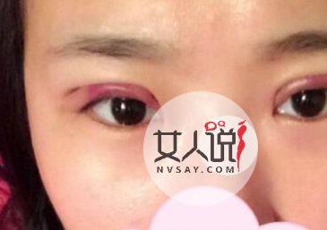 想要变美的你,了解韩式三点双眼皮价格吗?