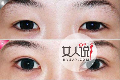 想要变美的你,了解韩式三点双眼皮价格吗?