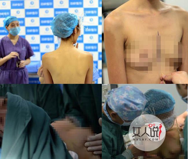 嫩模直播丰胸手术 全裸播放从扁平A罩杯到波涛汹涌过程