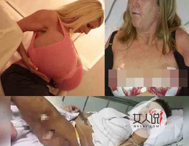 女子隆胸硅胶爆炸 飞机场变成大气球最终在体内爆破