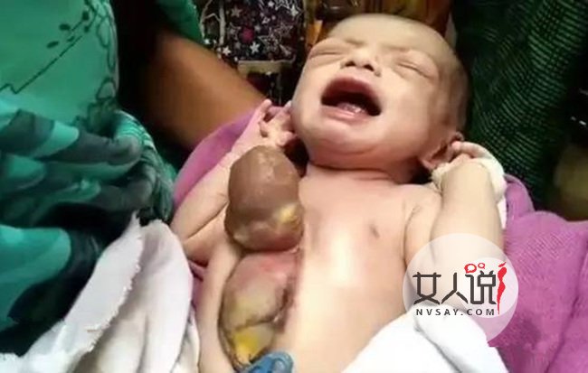 新生女婴心脏长胸外 全家陷入崩溃背后的真相令人震惊