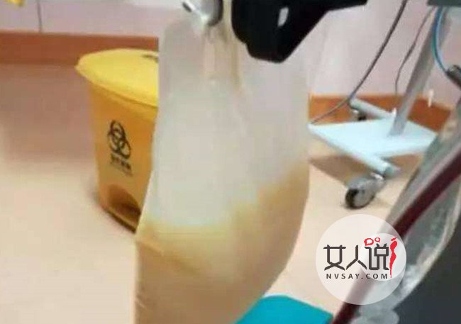 体内抽出牛奶血 不良饮食习惯竟出现白色液体血液