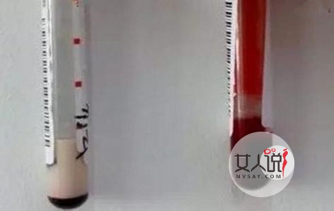 体内抽出牛奶血 不良饮食习惯竟出现白色液体血液