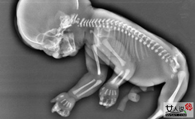 妈妈怀上人鱼宝宝 或因遗传基因致畸形不能生存下来