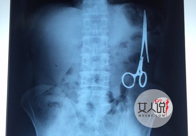 剪刀遗留腹中18年 揭剪刀遗留腹中真相令人唏嘘不已