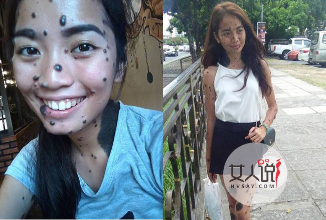 女子全身长满斑点 真人照片曝光很恐怖却满怀信心成环球小姐