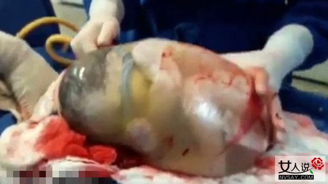 西班牙产妇产巨蛋 婴儿裹胎膜出生犹如透明鸡蛋令人称奇