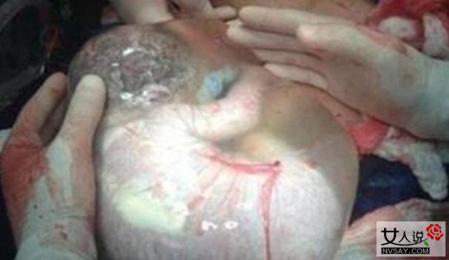 西班牙产妇产巨蛋 婴儿裹胎膜出生犹如透明鸡蛋令人称奇