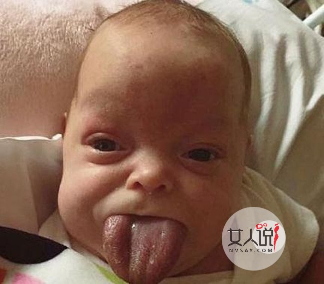 新生女婴长巨舌 惊人大舌头塞满嘴巴往外生长太可怕