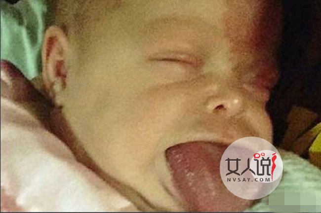 新生女婴长巨舌 惊人大舌头塞满嘴巴往外生长太可怕