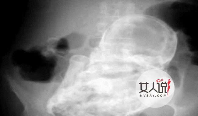 82岁老太突然怀孕 揭老蚌生珠真相始末令人惊呆不已