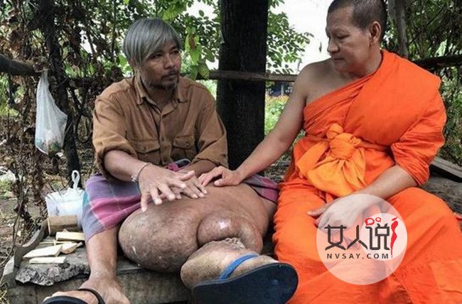 泰国男子长出象腿 因没钱久拖不治致腿部肿胀不堪好凄惨
