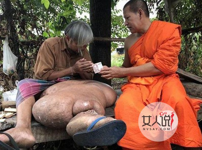 泰国男子长出象腿 因没钱久拖不治致腿部肿胀不堪好凄惨