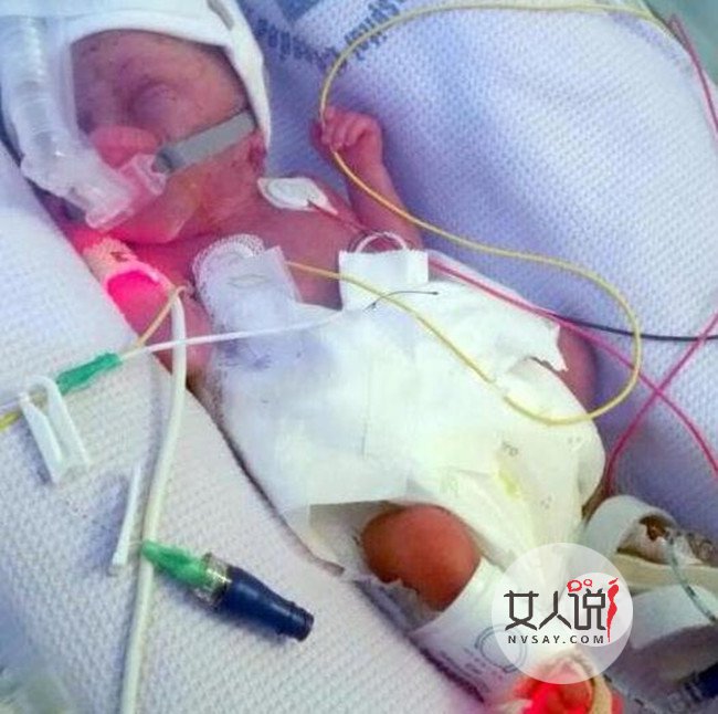 出生仅九两的婴儿奇迹存活 曾被医生断言无法存活下来