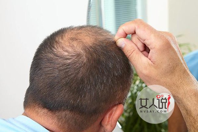 男士脱发原因及治疗 脱发严重?那快收走这几个解决偏方