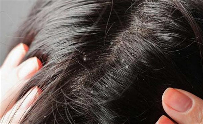头屑多掉头发的原因 脱发10大原因少不了头屑搞鬼