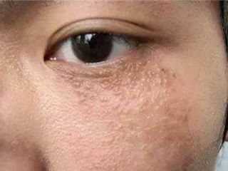 眼部扁平疣初期图片 扁平疣的早期症状80%的人都不知道