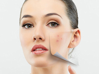 痘痘肌肤怎么改善 想拯救已毁容脸蛋就赶紧进来