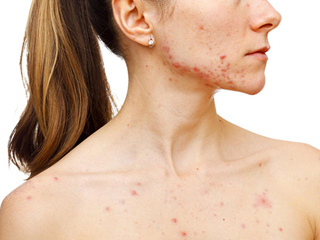 什么样的属于痘痘肌 关于痘痘肌你具体了解多少捏