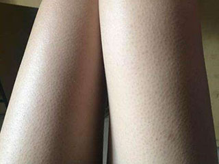 鸡皮疙瘩皮肤怎么治 鸡皮疙瘩长时间不消退身体在渴求它