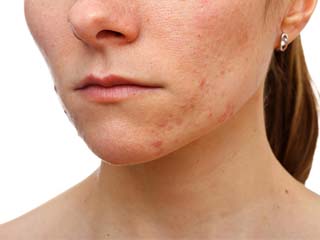 怎么判断脸上痘痘类型 分清痘痘种类方可消灭殆尽