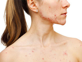 脖子上长痘痘怎么办 6招就帮你恢复无痘天鹅颈