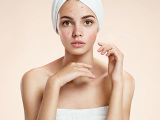 痘痘不挤自己会好吗 除了挤和自愈小编再分享别的方法