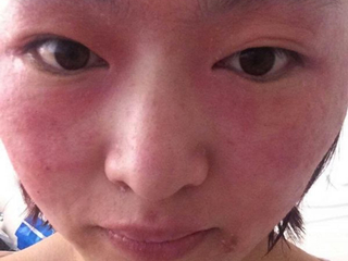 学生去痘印小妙招 教你怎么用根源上彻底治疗痘印