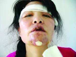 娇玛仕玻尿酸毁容案例 玻尿酸毁容事件图片曝光整容需谨慎