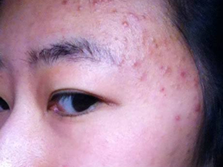毛囊炎最佳治疗方法 看看毛囊炎图片到底怎么治疗最好