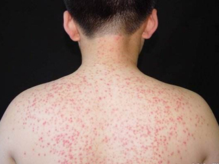 毛囊炎是怎么引起的 毛囊炎的病理原因及症状分析不得不知